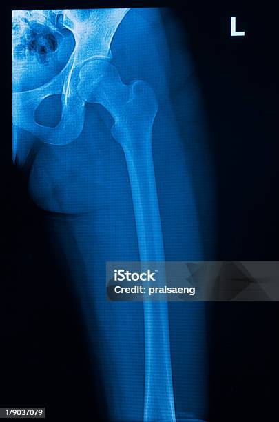 Anca De Radiografia Humana - Fotografias de stock e mais imagens de Adulto - Adulto, Anatomia, Coluna vertebral - Parte do corpo