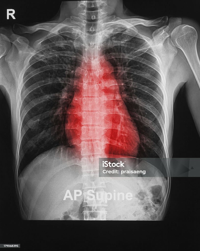 a imagem de raio-x de um humano peito - Foto de stock de Anatomia royalty-free