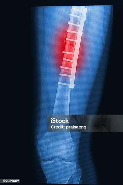 Foto de Quebrado Coxa Humanos Imagem De Raiosx Com Implante e mais fotos de stock de Acidente