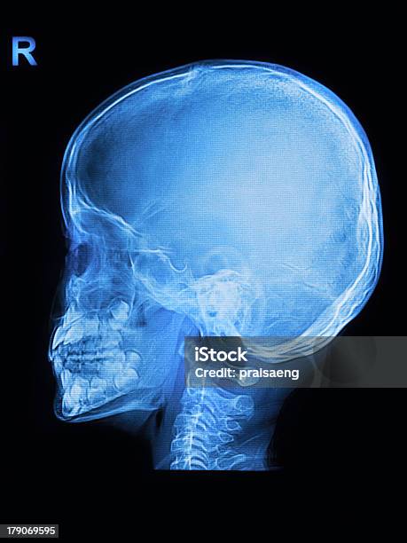 Photo libre de droit de Enfants Crâne Rayons X Image banque d'images et plus d'images libres de droit de Anatomie - Anatomie, Blessure physique, Centre médical