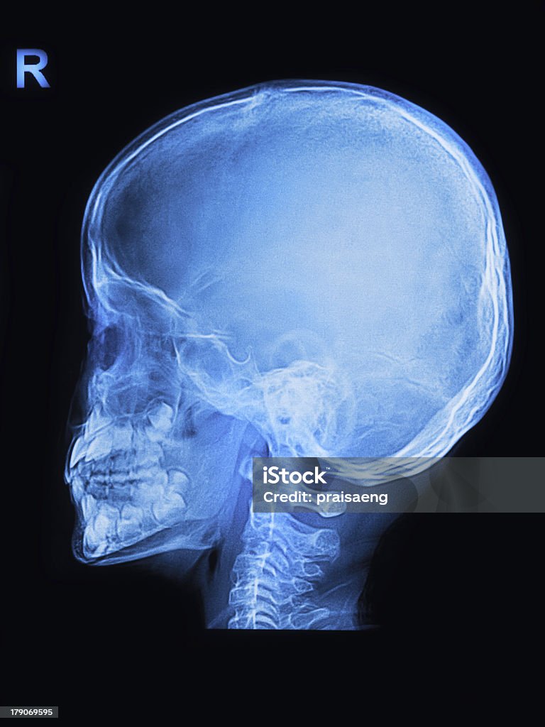 보그다 스컬 x-레이 이미지 - 로열티 프리 건강관리와 의술 스톡 사진