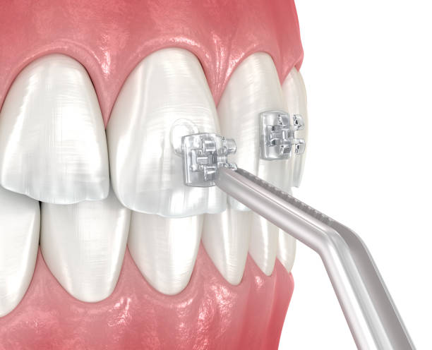 istock Clear braces placement over tooth. Dental 3D illustration 1791103023
