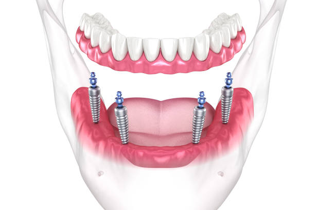 Mandibular removable prosthesis All on 4 system supported by implants with ball attachments. Medically accurate dental 3D illustration Mandibular removable prosthesis All on 4 system supported by implants with ball attachments. Medically accurate dental 3D illustration dental implant stock pictures, royalty-free photos & images