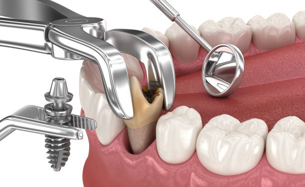 istock Extraction and Implantation, complex immediate surgery. Medically accurate 3D illustration of dental treatment 1791103548