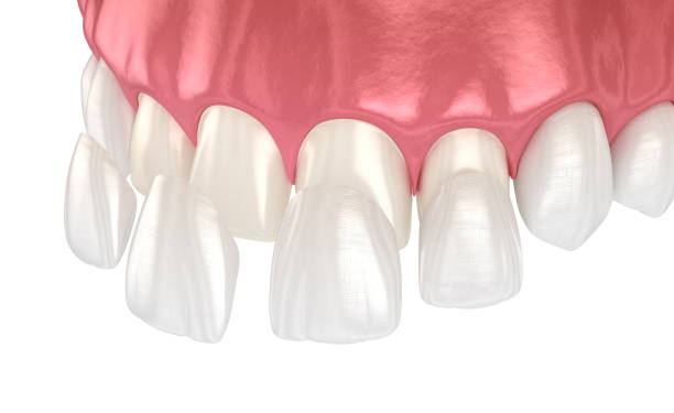 istock Dental veneer placement over frontal teeth. 3D illustration 1791103569