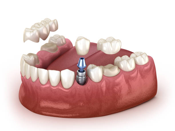 recuperación dental con implante de corona y puente. concepto dental de ilustración 3d médicamente preciso. - premolar fotografías e imágenes de stock