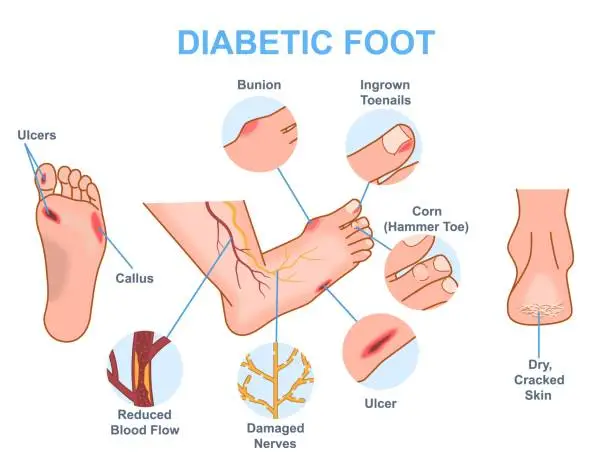 Vector illustration of Diabetic foot medical vector diagram