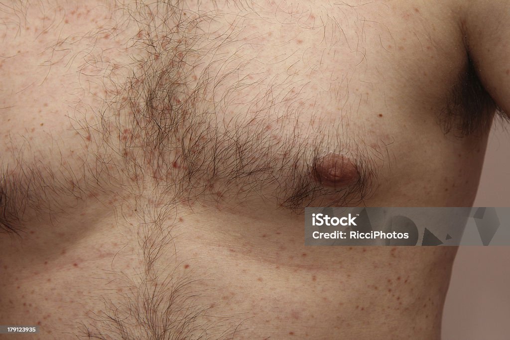Mastocitosis - Foto de stock de Herida libre de derechos