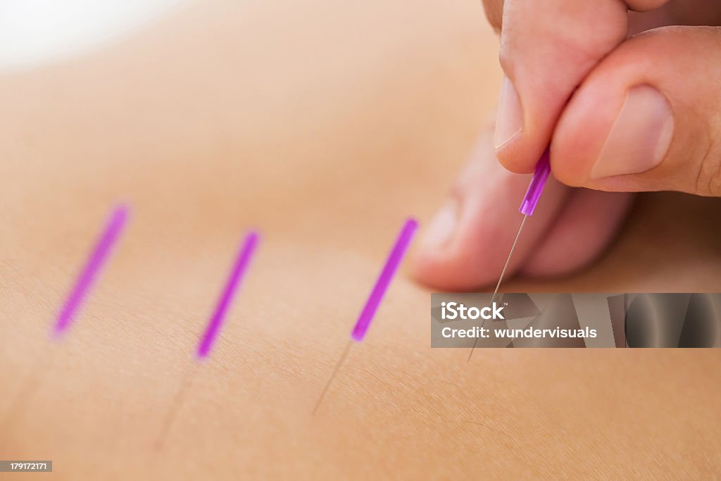 O doente e tratamento de acupuntura nas costas - Royalty-free Acupuntura Foto de stock