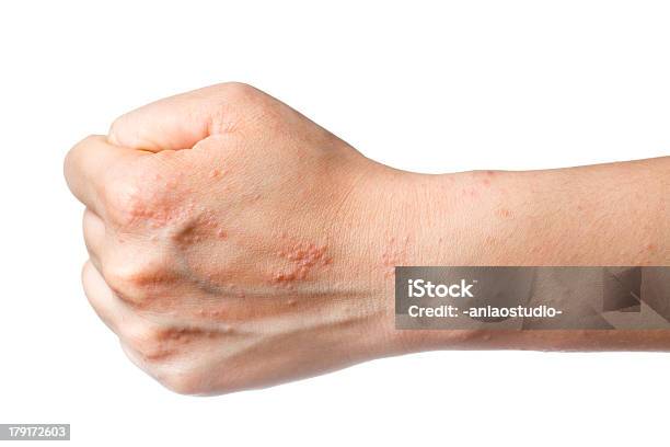 Eczema Haut Auf Seite Stockfoto und mehr Bilder von Atopisches Ekzem - Atopisches Ekzem, Handfläche, Hautfleck