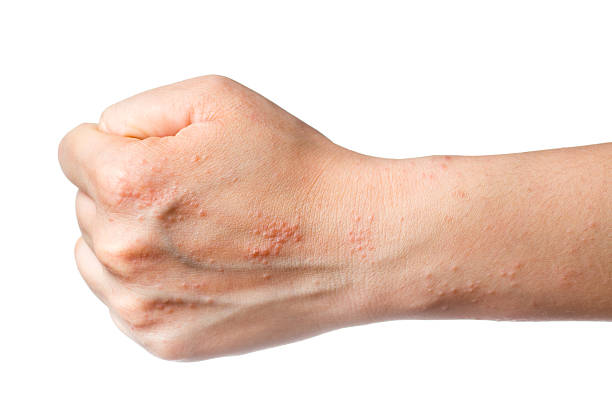 istock eczema skin on hand 179172603