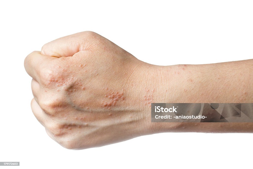 eczema pele à mão - Foto de stock de Eczema atópico royalty-free