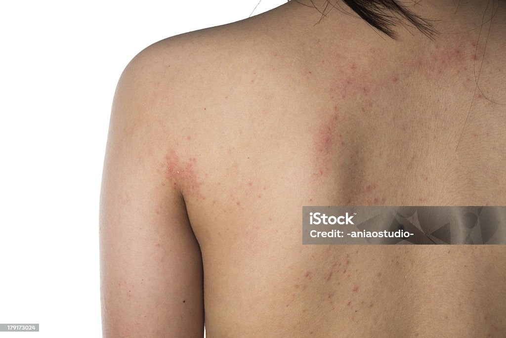 eczema Haut der hinten-Struktur - Lizenzfrei Rücken Stock-Foto