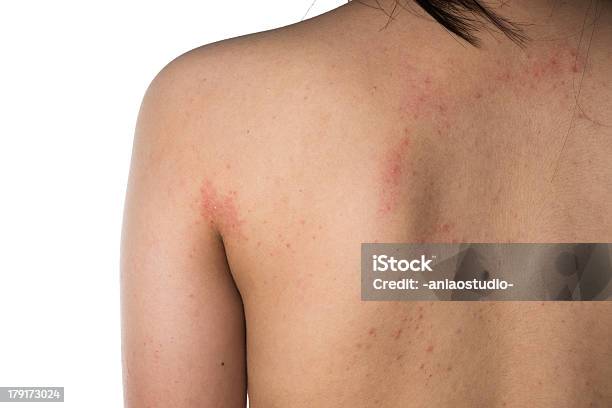 Eczema Haut Der Hintenstruktur Stockfoto und mehr Bilder von Rücken - Rücken, Ekzem, Rückansicht