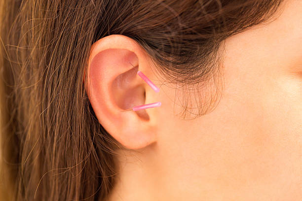 istock Doctor's hand with acupuncture needles in ear of patient 179190480