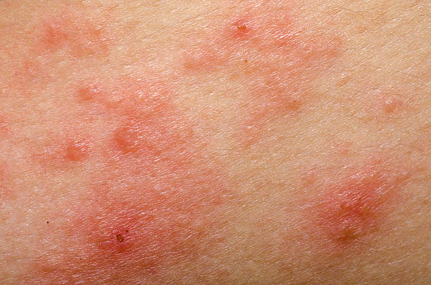 Skala objawów atopowego zapalenia skóry skóry – zdjęcie