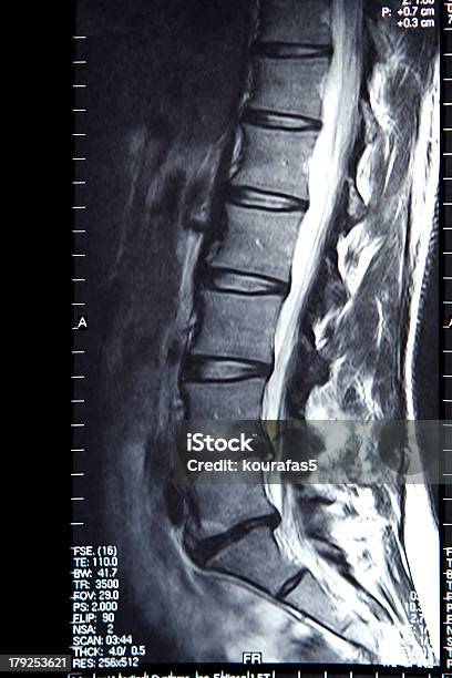 Mri W Dolnej Części Pleców - zdjęcia stockowe i więcej obrazów Obrazowanie magnetyczno-rezonansowe - Obrazowanie magnetyczno-rezonansowe, Skaner MRI, Kolumna architektoniczna