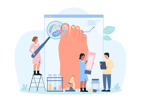 Diagnosis and treatment of fungal infection and nail disease, onychomycosis vector illustration. Cartoon tiny doctors with magnifying glass diagnose microbes on feets skin, advise antifungal treatment