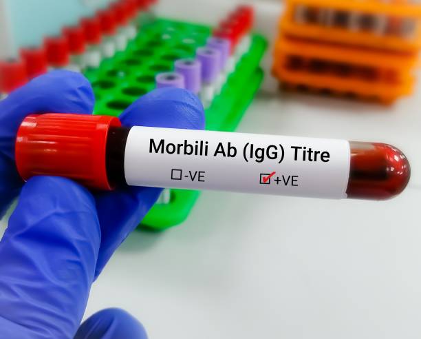 istock Blood sample for Morbilli Ab IgG, measles 1792780983