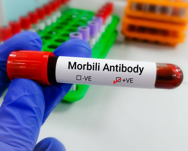 istock Blood sample for Morbilli Antibody, measles 1792782018