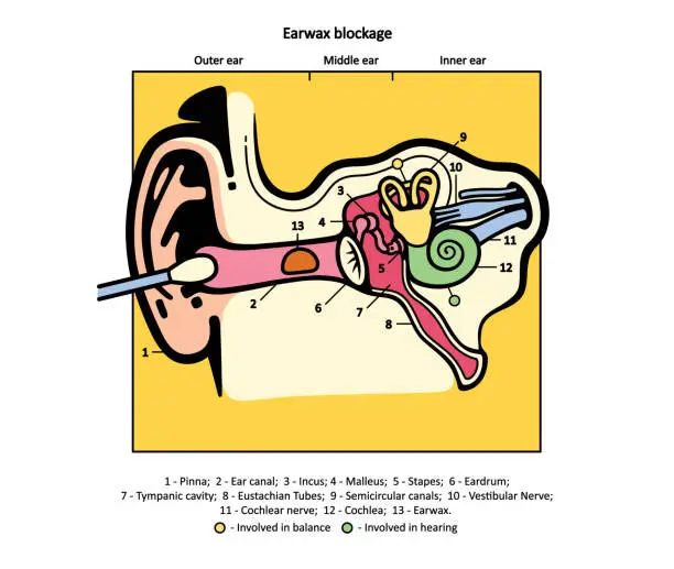 Vector illustration of Earwax blockage