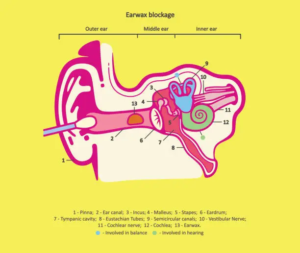 Vector illustration of Earwax blockage