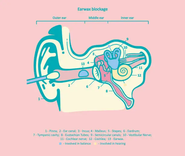 Vector illustration of Earwax blockage