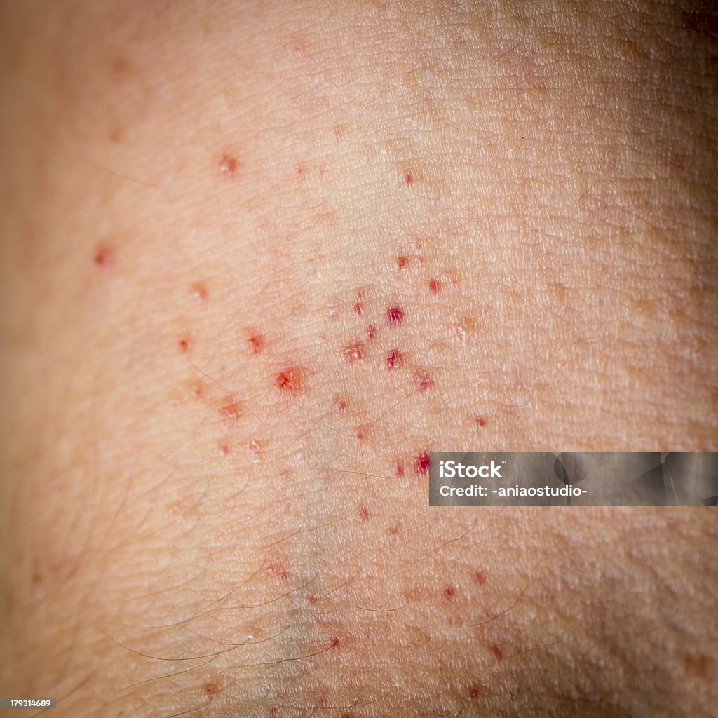 eczema お肌の質感 - アトピー性皮膚炎のロイヤリティフリーストックフォト