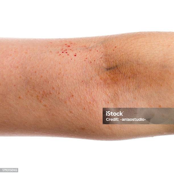 Eczema Skin On Hand Stock Photo - Download Image Now - Allergy, Atopic Eczema, Close-up