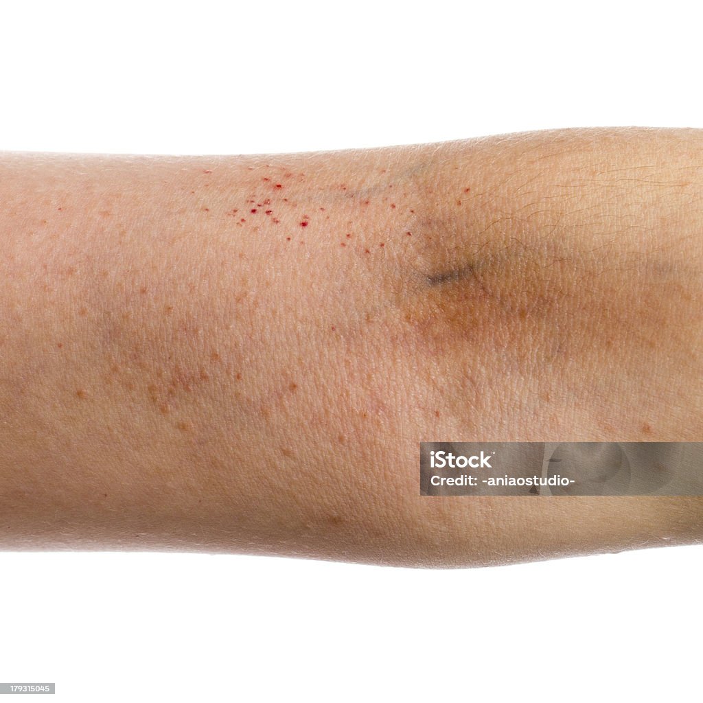 eczema pele à mão - Foto de stock de Alergia royalty-free