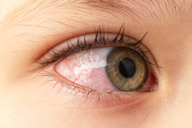 closeup irrité les yeux injectés de sang rouges infectés, conjonctivite - conjunctivitis sore eyes child human eye photos et images de collection