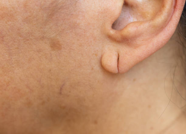 woman's ear with cut on the lobe from ripping out an earring piercing divide the hole into a scar.earlobe woman's ear with cut on the lobe from ripping out an earring piercing divide the hole into a scar.earlobe Earlobe stock pictures, royalty-free photos & images