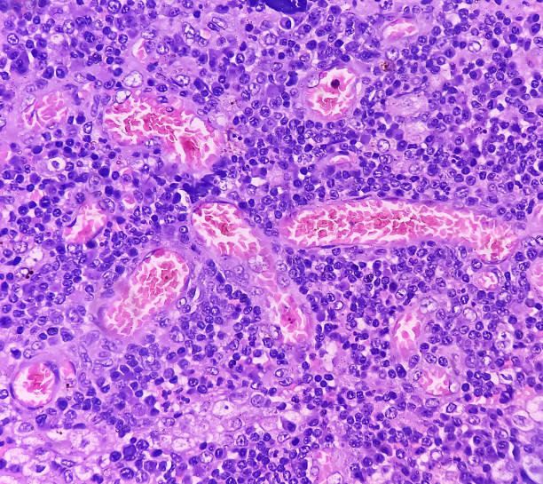 leistenlymphknoten (herausgeschnitten): lymphoproliferative störung (lpd). schnitt mit lymphknoten. - hodgkins disease stock-fotos und bilder