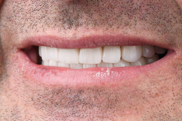 istock Emax crowns and veneers on teeth and implants 1794543525