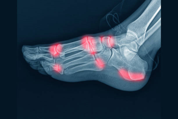 Digital medical illustration: Lateral (side) x-ray view (orthogonal) of human foot and ankle. Featuring: