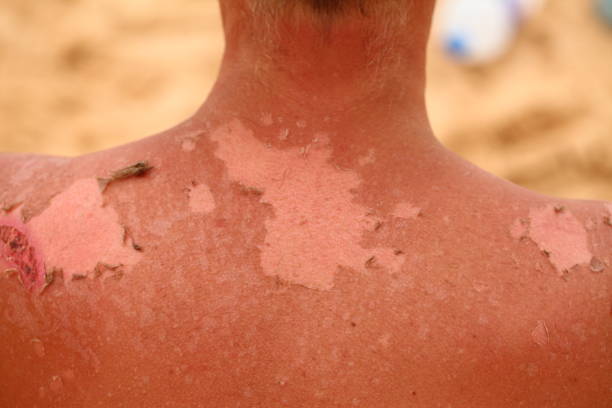istock sunburn skin  on the back of a man 1794918636