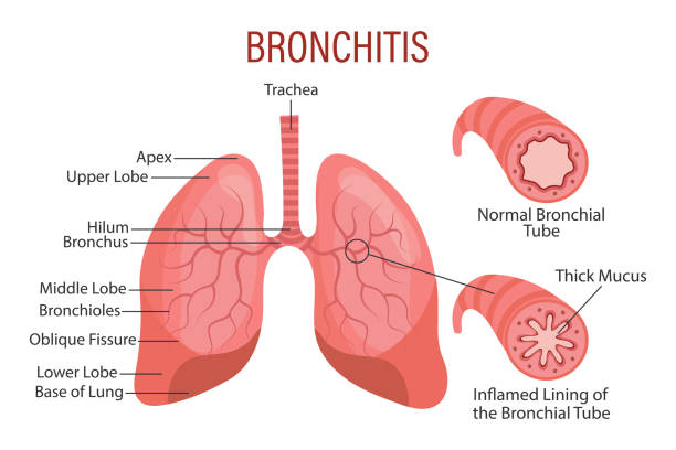 Bronchitis, a lung disease. Healthcare. Medical infographic banner, illustration Bronchitis, a lung disease. Healthcare. Medical infographic banner, illustration, vector erythema nodosum stock illustrations