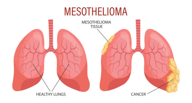 Stages of mesothelioma, lung disease. Healthcare. Medical infographic banner, illustration Stages of mesothelioma, lung disease. Healthcare. Medical infographic banner, illustration, vector erythema nodosum stock illustrations