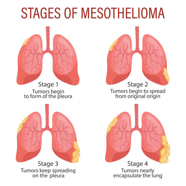 Stages of mesothelioma, lung disease. Healthcare. Medical infographic banner, illustration Stages of mesothelioma, lung disease. Healthcare. Medical infographic banner, illustration, vector erythema nodosum stock illustrations