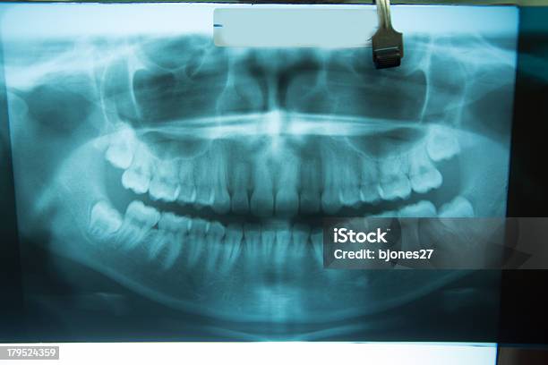 건강한 구강 X선 X-레이에 대한 스톡 사진 및 기타 이미지 - X-레이, 건강 검진, 건강 진단