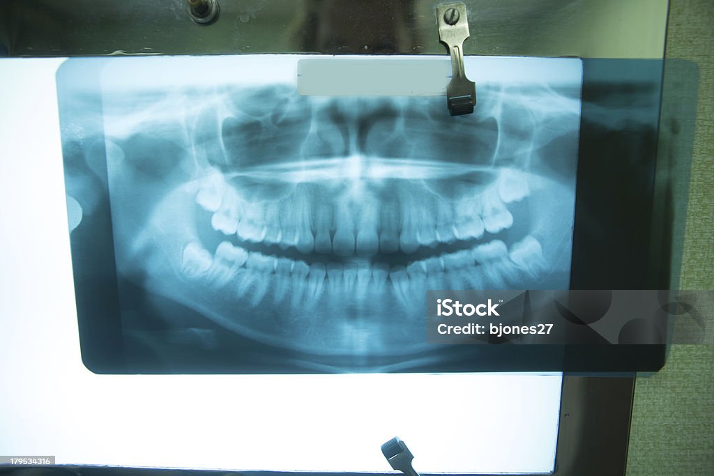 healthy mouth x-ray healthy mouth x-ray of 20 year old woman Adult Stock Photo