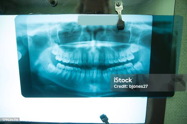 Healthy Mouth Xray Stock Photo - Download Image Now - Adult, Aspirations, Blue