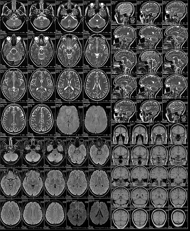 MRI or magnetic resonance imaging of the head and brain