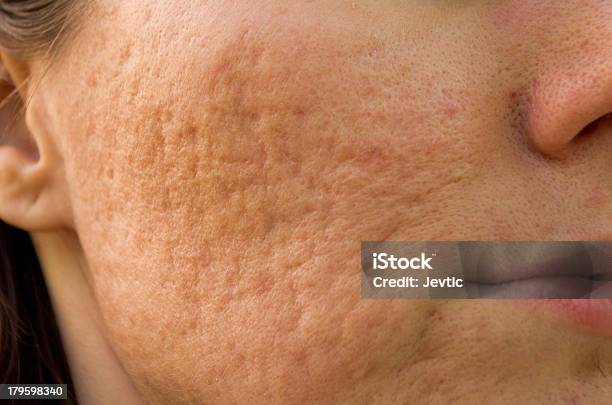 Foto de Marcas De Acne e mais fotos de stock de Acne - Acne, Cicatriz, Pontilhado