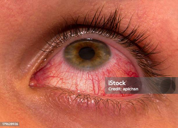 The Aggravation After Working At Computer Stock Photo - Download Image Now - Allergy, Astigmatism, Close-up