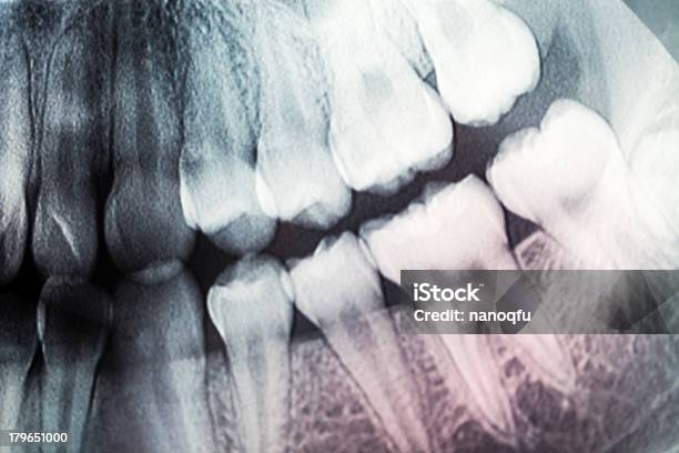 X Ray Of Teeth Stock Photo - Download Image Now - Anatomy, Black Color, Data