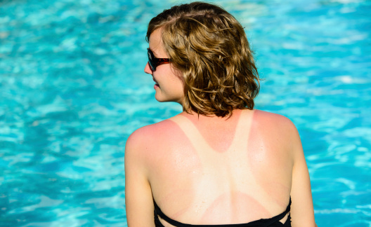 A smiling female sitting next to a pool with a tan line and sunburn on her back.
