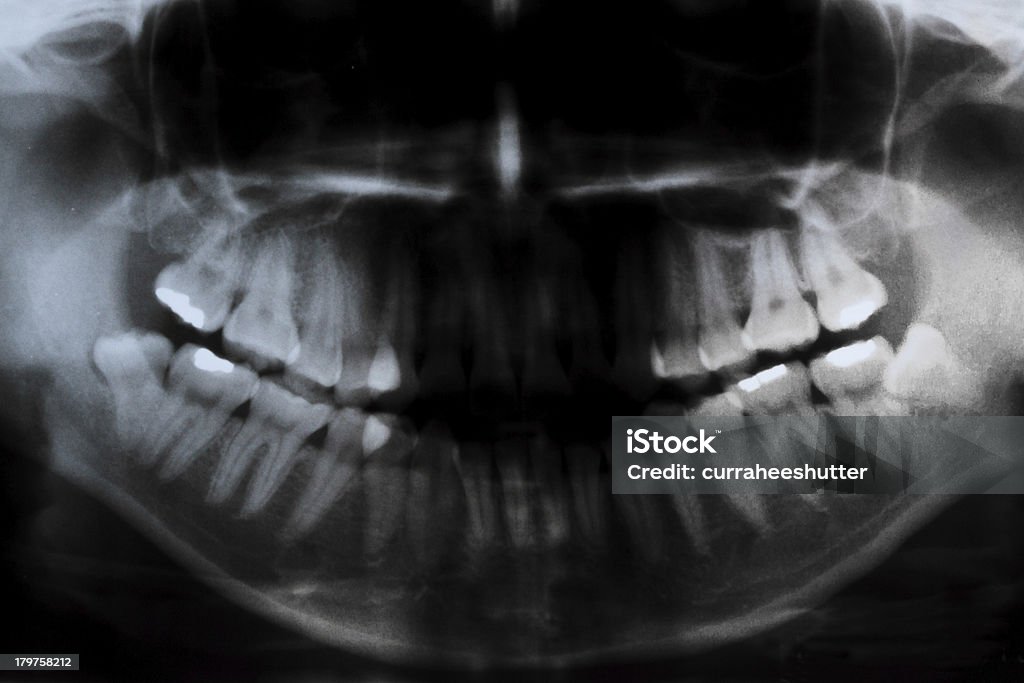 Radiografia panorâmica dental - Royalty-free Fratura Foto de stock