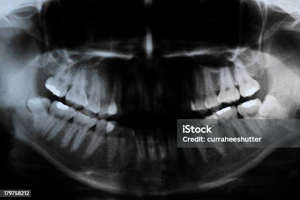 Radiografia Panorâmica Dental - Fotografias de stock e mais imagens de Fratura - Fratura, Imagem de raios X, Anatomia