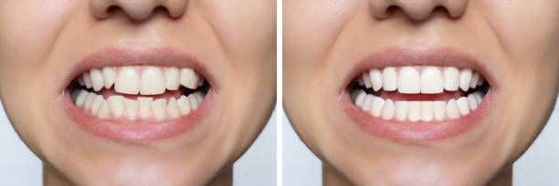 istock Young woman's smile before and after teeth straightening 1798580459